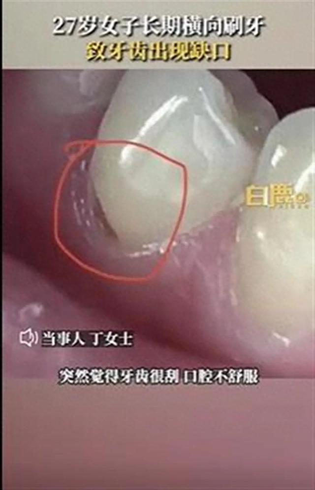 kaiyun官方网站下载“27岁女子长期横向刷牙致牙齿缺损”上热搜专家提醒(图1)